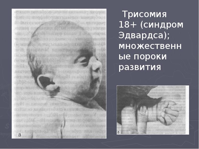 Трисомия 18+ (синдром Эдвардса); множественные пороки развития   Трисомия 18+