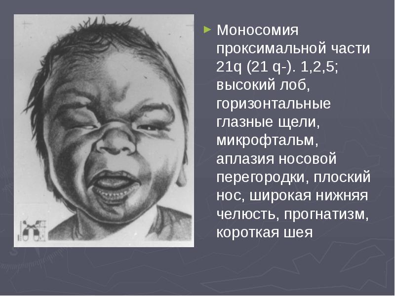 Моносомия проксимальной части 21q (21 q-). 1,2,5; высокий лоб, горизонтальные глазные