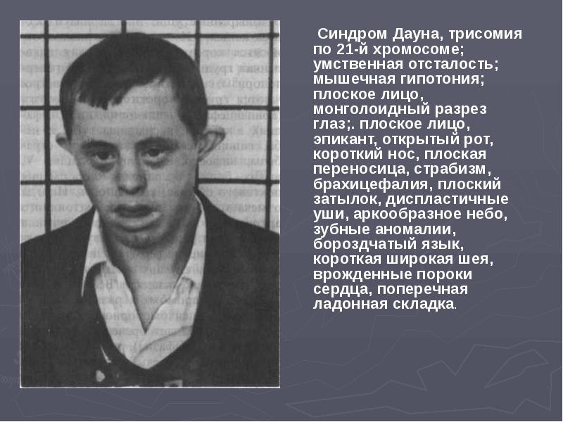 Синдром Дауна, трисомия по 21-й хромосоме; умственная отсталость; мышечная гипотония; плоское