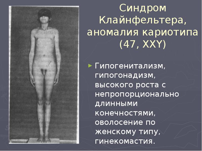 Синдром Клайнфельтера, аномалия кариотипа (47, XXY) Гипогенитализм, гипогонадизм, высокого роста с
