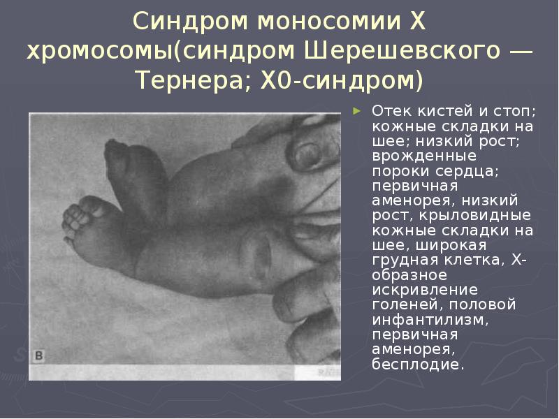 Синдром моносомии Х хромосомы(синдром Шерешевского — Тернера; Х0-синдром) Отек кистей и