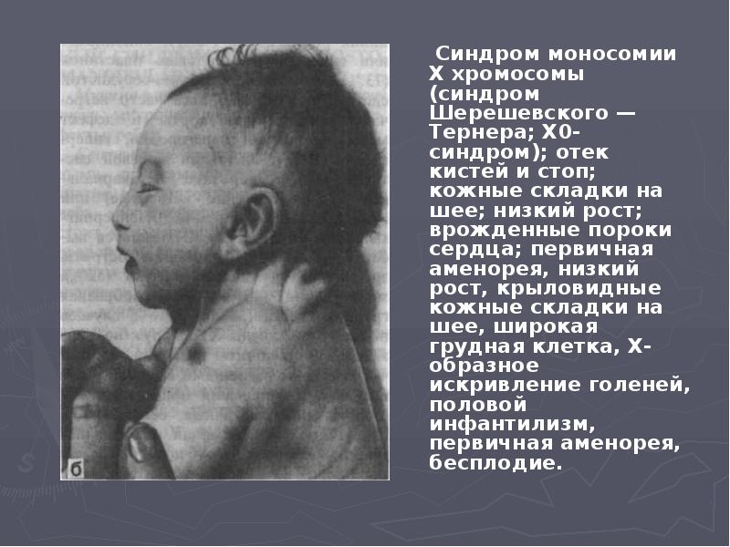 Синдром моносомии Х хромосомы (синдром Шерешевского — Тернера; Х0-синдром); отек кистей