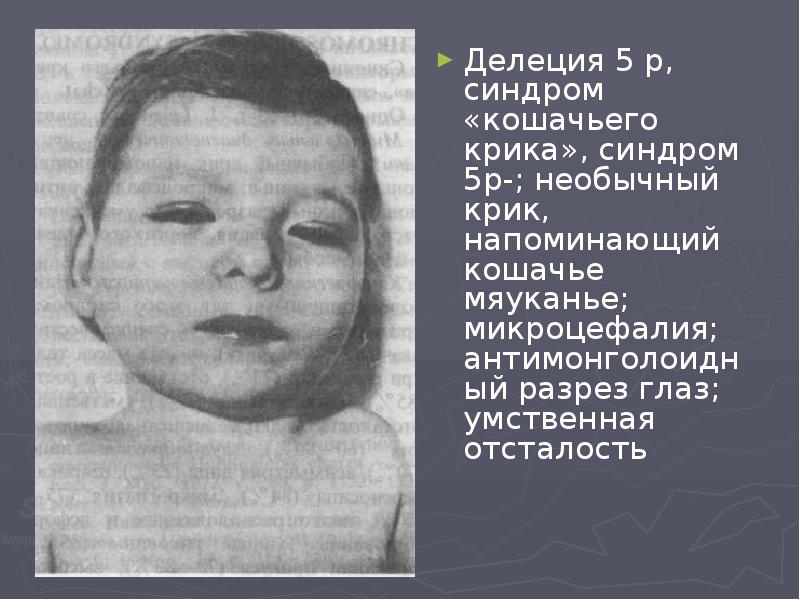 Делеция 5 р, синдром «кошачьего крика», синдром 5p-; необычный крик, напоминающий