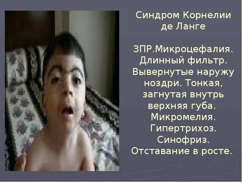 Синдром Корнелии де Ланге  ЗПР.Микроцефалия. Длинный фильтр. Вывернутые наружу ноздри.