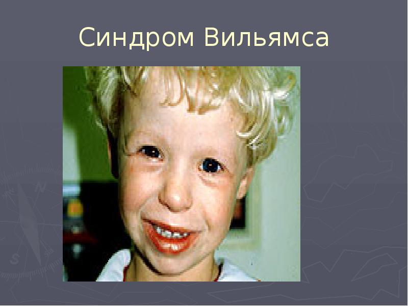 Синдром Вильямса