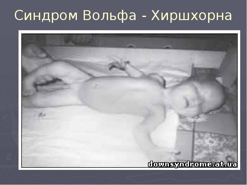 Синдром Вольфа - Хиршхорна