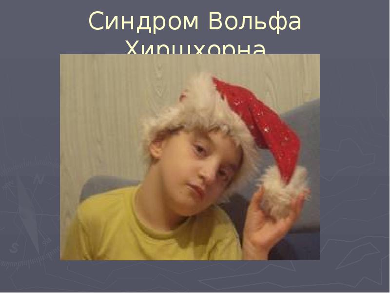Синдром Вольфа Хиршхорна