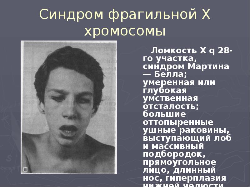 Синдром фрагильной Х хромосомы    Ломкость X q 28-го