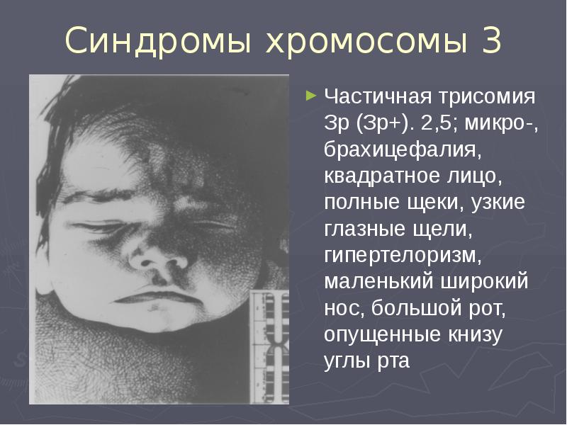 Синдромы хромосомы 3 Частичная трисомия Зр (Зр+). 2,5; микро-, брахицефалия, квадратное