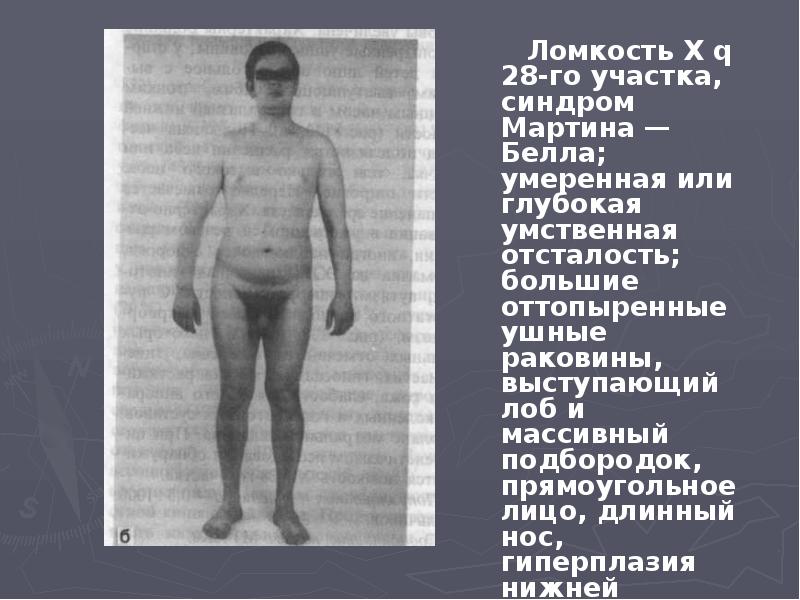 Ломкость X q 28-го участка, синдром Мартина — Белла; умеренная или