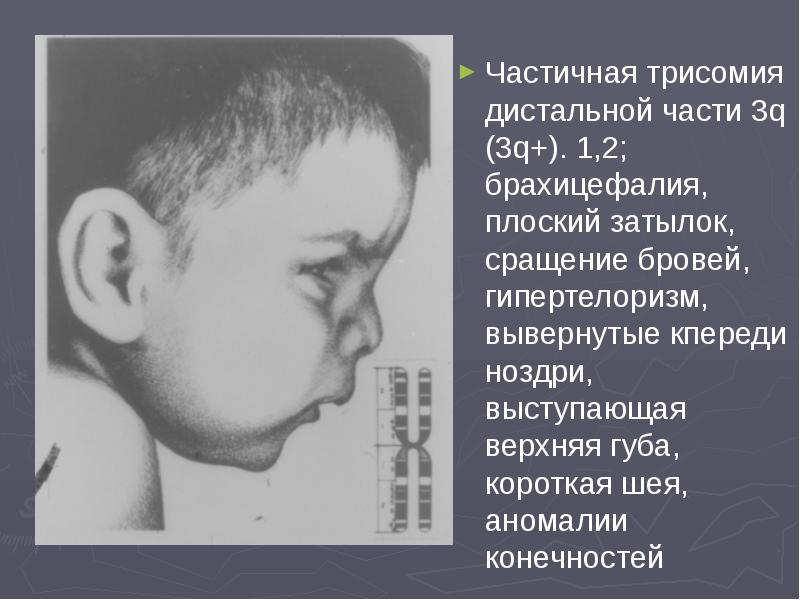 Частичная трисомия дистальной части 3q (3q+). 1,2; брахицефалия, плоский затылок, сращение