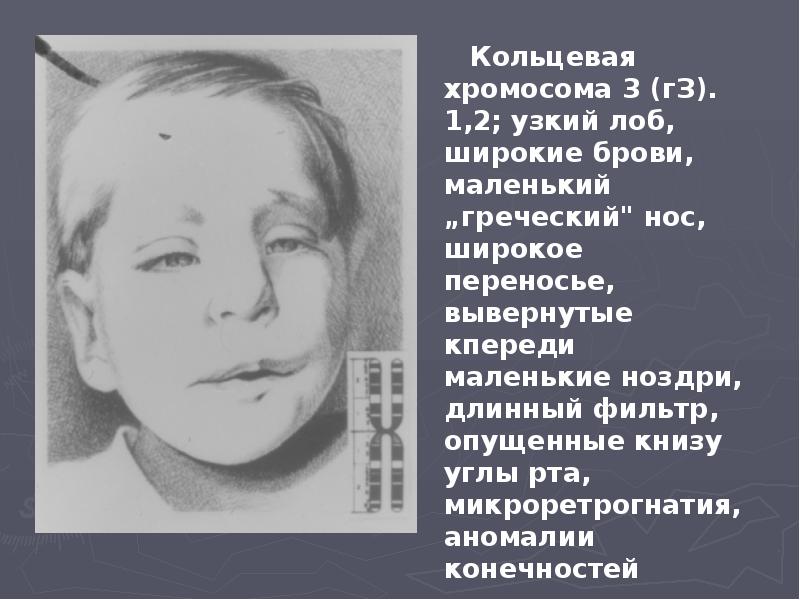 Кольцевая хромосома 3 (гЗ). 1,2; узкий лоб, широкие брови, маленький „греческий"
