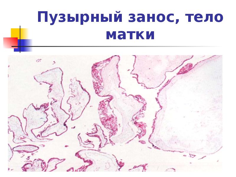 Трофобластическая болезнь презентация