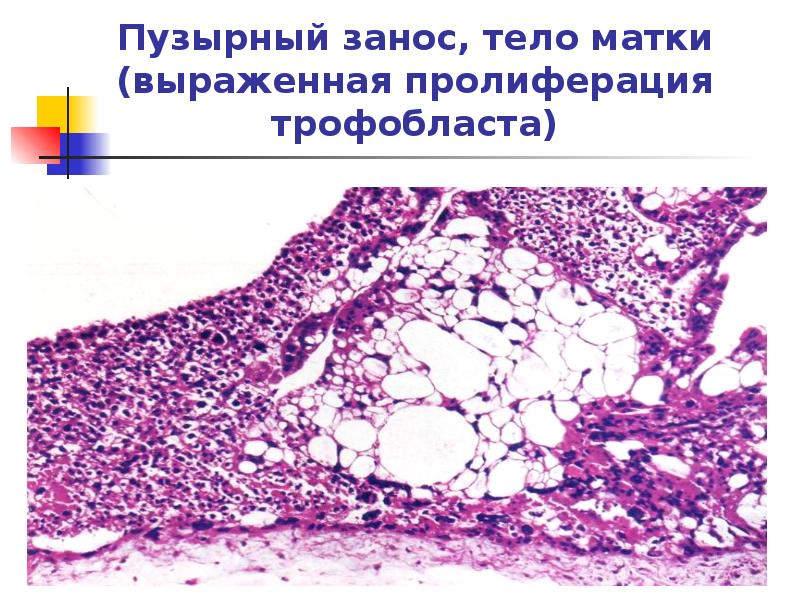 Пузырный занос, тело матки (выраженная пролиферация трофобласта) Пузырный занос, тело матки (выраженная пролиферация трофобласта)