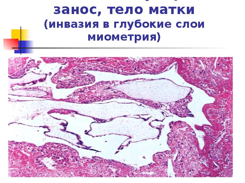 Инвазивный пузырный занос, тело матки (инвазия в глубокие слои миометрия) Инвазивный пузырный занос, тело матки (инвазия в глубокие слои миометрия)