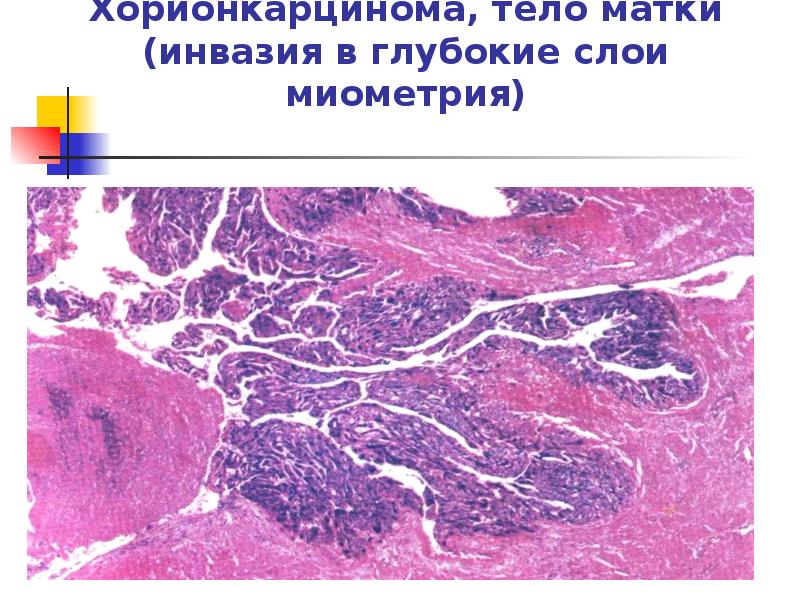 Хорионкарцинома, тело матки (инвазия в глубокие слои миометрия) Хорионкарцинома, тело матки (инвазия в глубокие слои миометрия)