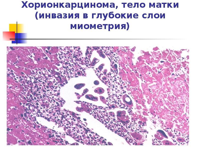 Трофобластическая болезнь презентация