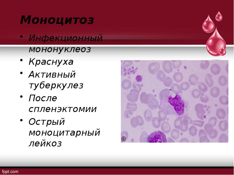 Миеломоноцитарный лейкоз картина крови