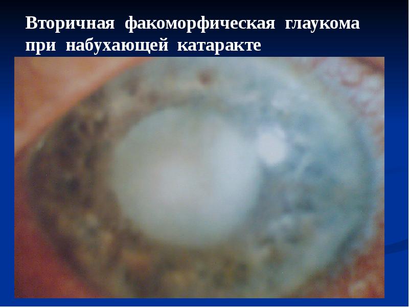 Глаукома. Классификация, лечение