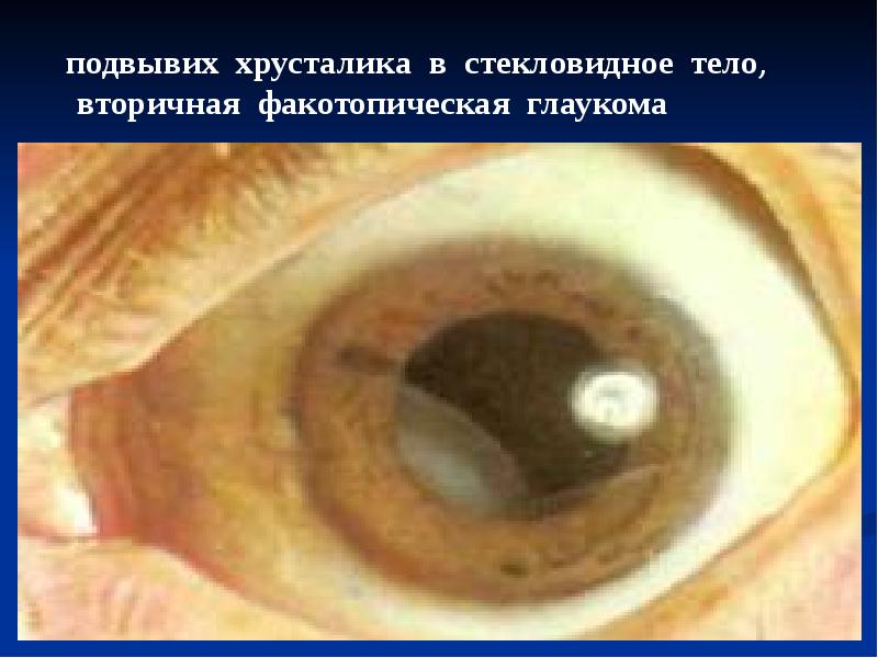 Глаукома. Классификация, лечение