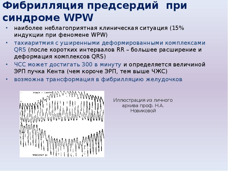 Как снять приступ мерцательной. Wpw с фибрилляцией. Фибрилляция предсердий с аберрантными комплексами. Синдром фибрилляции предсердий. Фибрилляция предсердий при синдроме wpw.