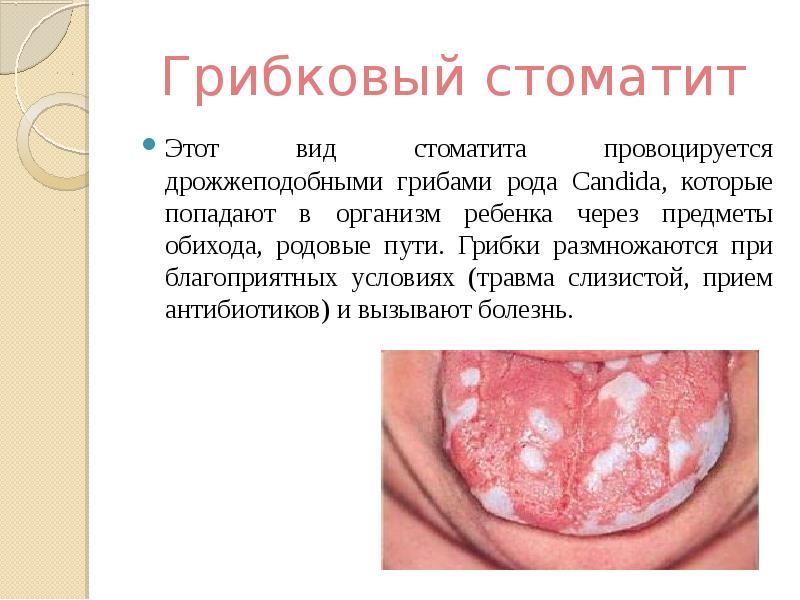 Презентация на тему стоматит у детей