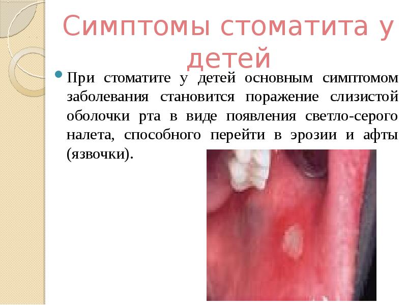 Презентация на тему стоматит у детей