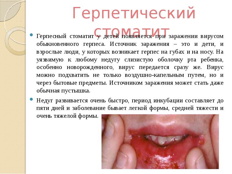 Презентация на тему стоматит у детей