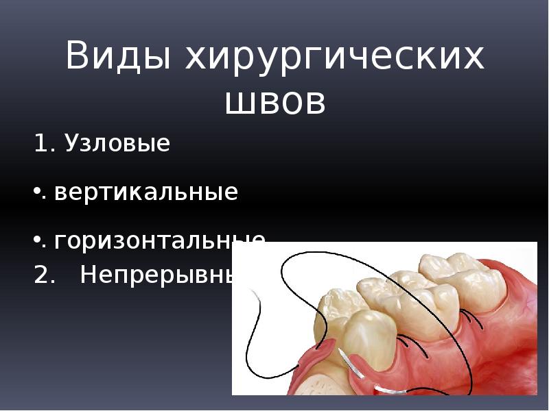 Хирургические швы презентация