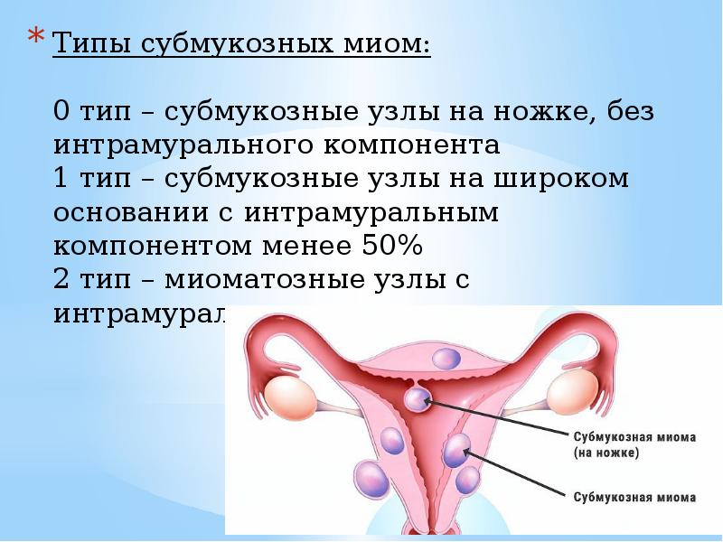 Узел в матке. Интрамуральные миоматозные узлы матки. Интрамурально субмукозная узел миома. Типы субмукозных миоматозных узлов. Интрамуральная субмукозная миома матки что это такое.