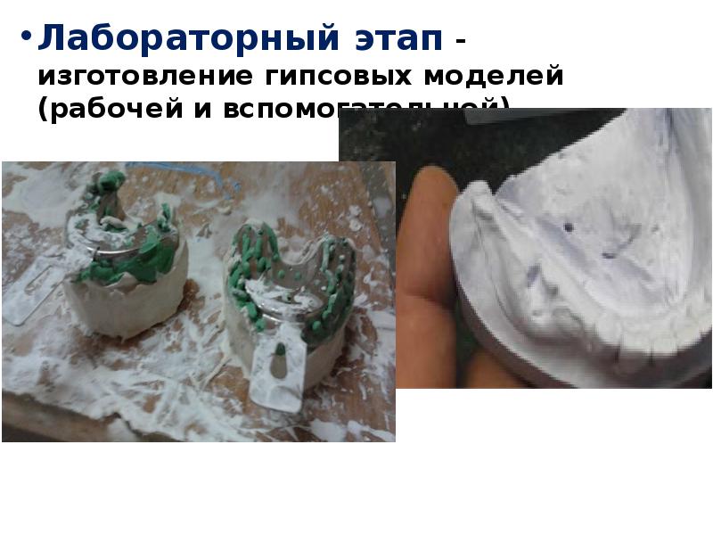 Лабораторный этап - изготовление гипсовых моделей (рабочей и вспомогательной). Лабораторный этап