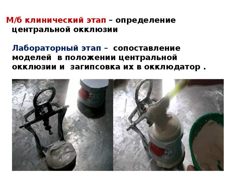 М/б клинический этап – определение центральной окклюзии   Лабораторный этап