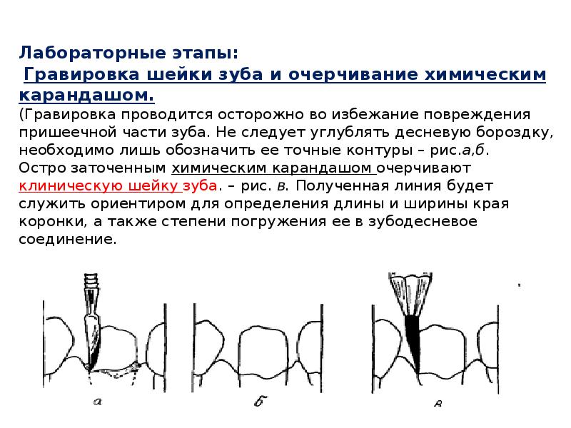 Лабораторные этапы:  Гравировка шейки зуба и очерчивание химическим карандашом. (Гравировка