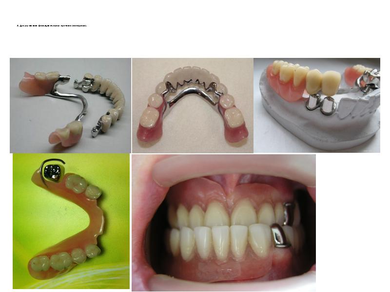 4. Для улучшения фиксации съемных протезов (контурные).