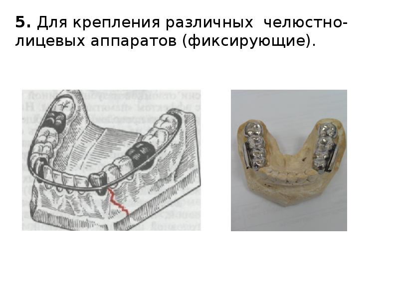 5. Для крепления различных челюстно-лицевых аппаратов (фиксирующие).