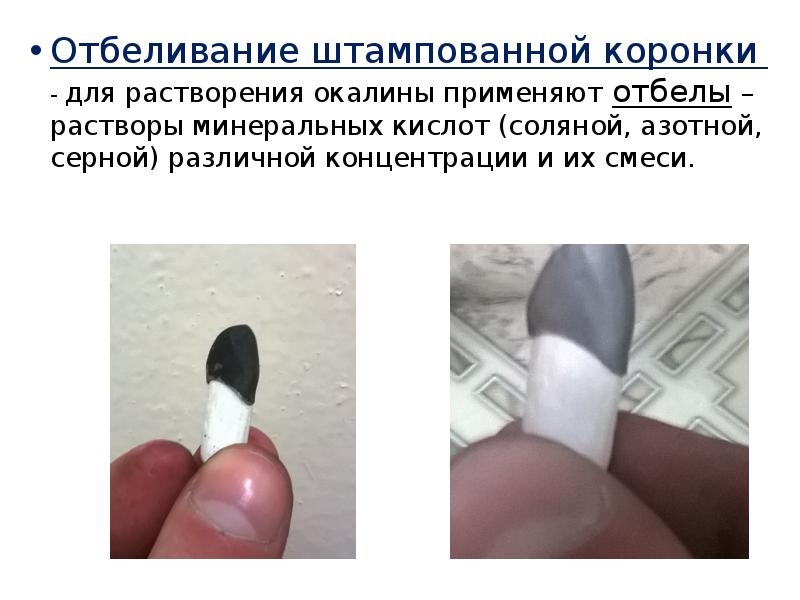 Отбеливание штампованной коронки - для растворения окалины применяют отбелы – растворы