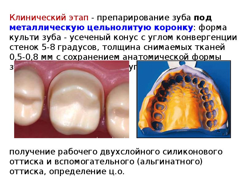 Клинический этап - препарирование зуба под металлическую цельнолитую коронку: форма культи