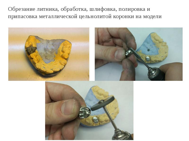 Обрезание литника, обработка, шлифовка, полировка и припасовка металлической цельнолитой коронки на