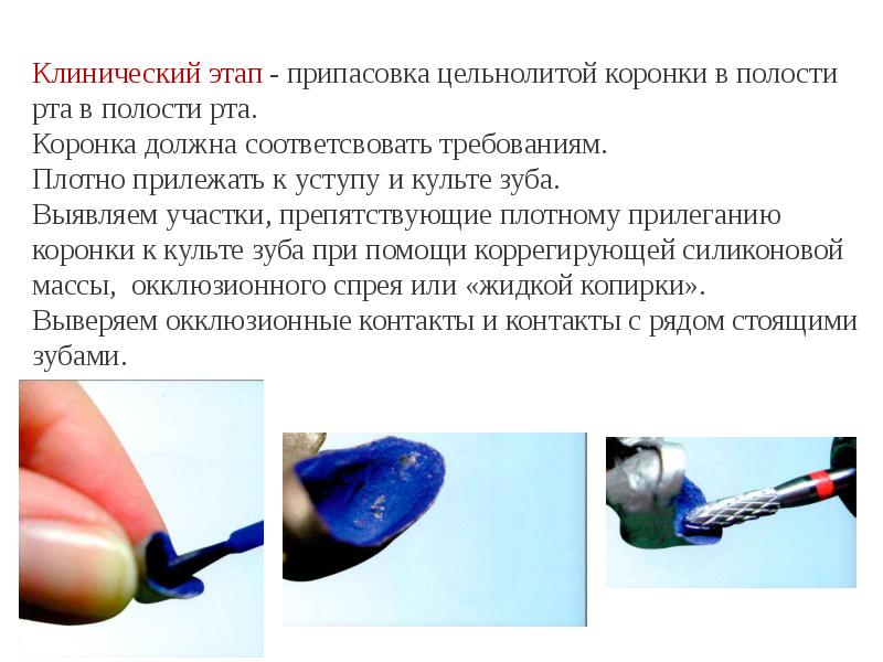 Клинический этап - припасовка цельнолитой коронки в полости рта в полости