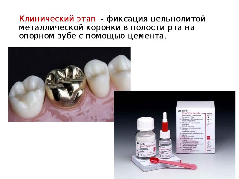 Клинический этап - фиксация цельнолитой металлической коронки в полости рта на