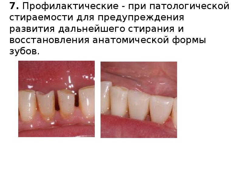 7. Профилактические - при патологической стираемости для предупреждения развития дальнейшего стирания