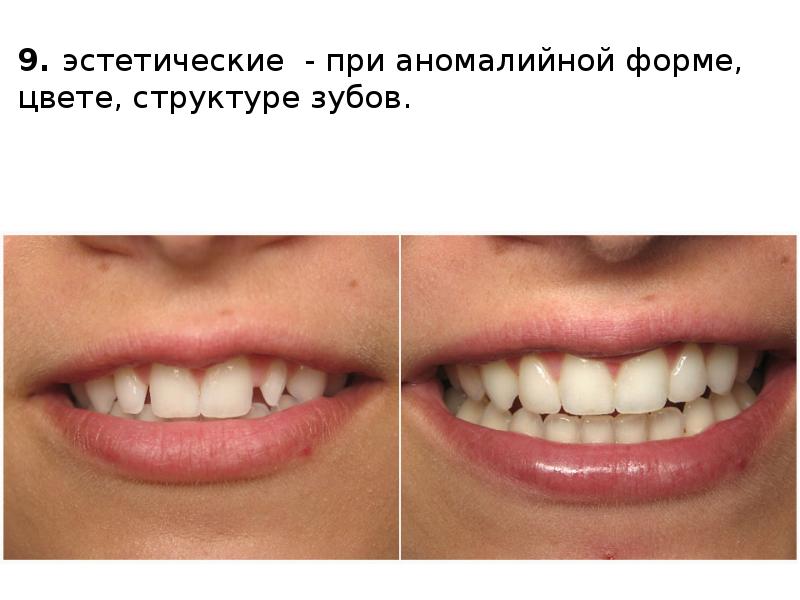 9. эстетические - при аномалийной форме, цвете, структуре зубов.