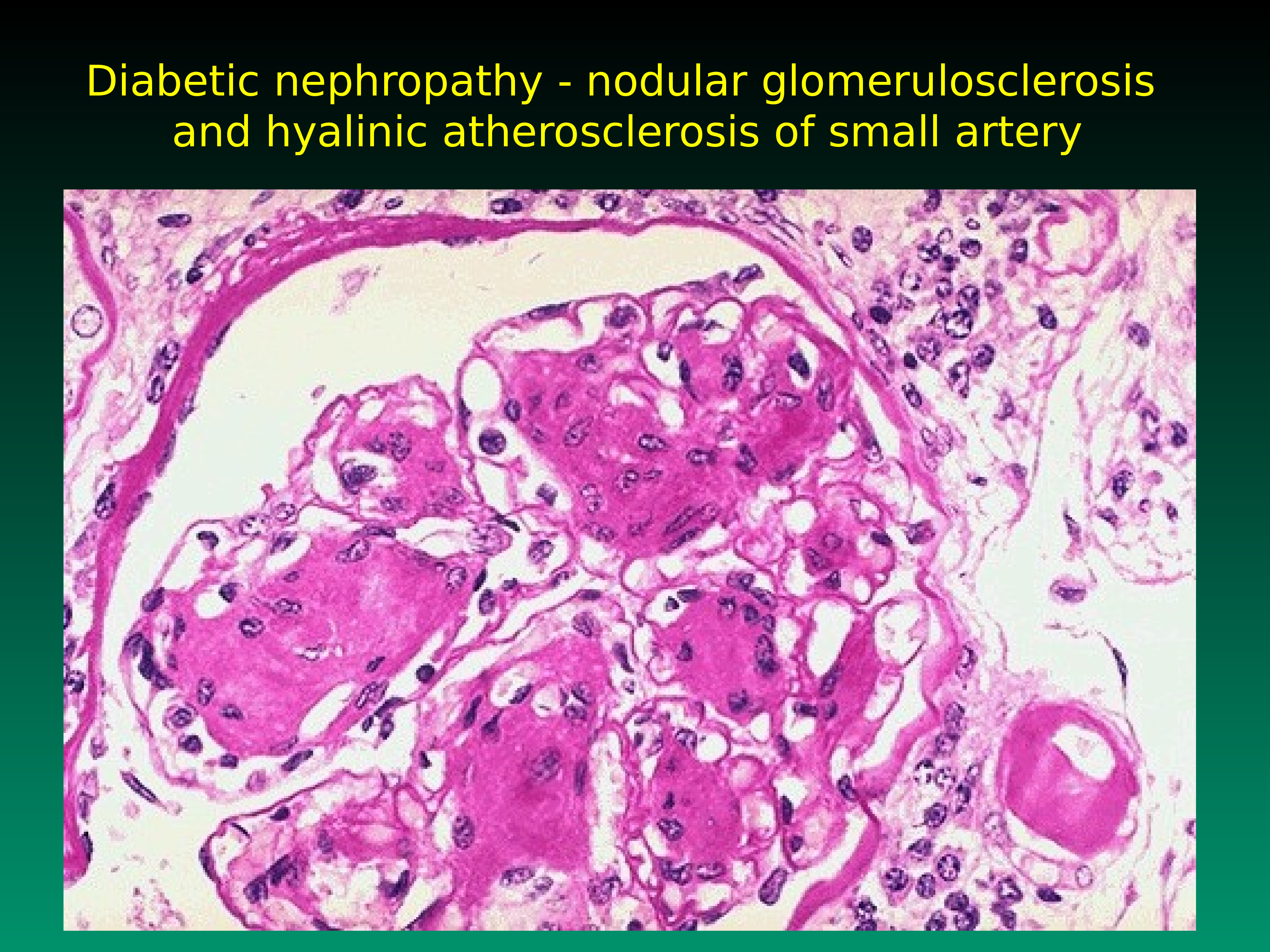 Почки при диабете. Гиалиноз капиллярных петель клубочков почки. Гломерулосклероз диабетическая нефропатия. Диабетический гломерулосклероз микропрепарат. Гиалиноз артериол селезенки.