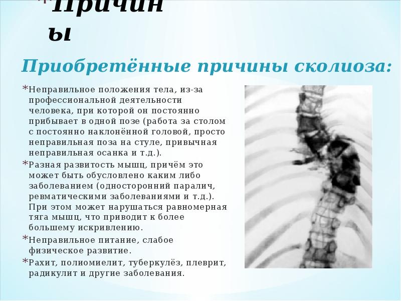 Причины
Приобретённые причины сколиоза: Причины
Приобретённые причины сколиоза: