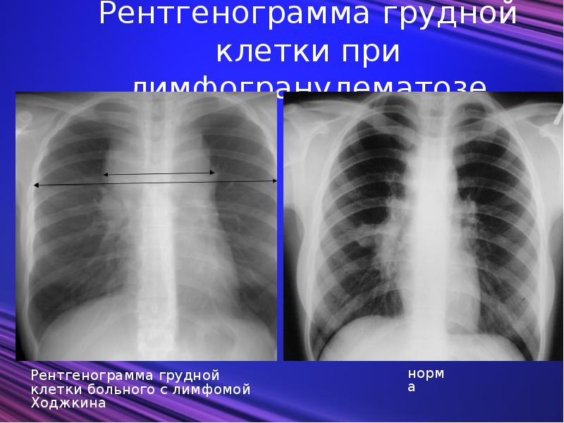 Болезнь ходжкина фото