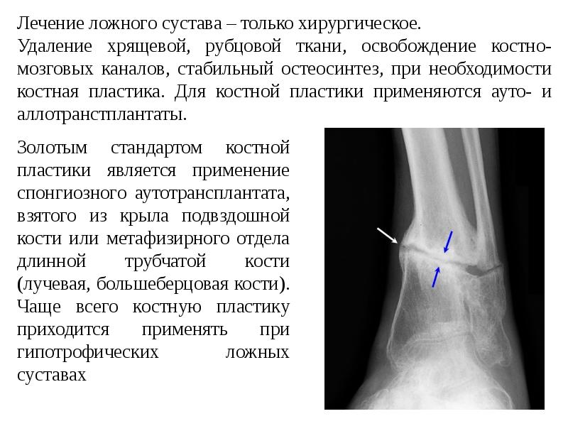 Ложный сустав презентация