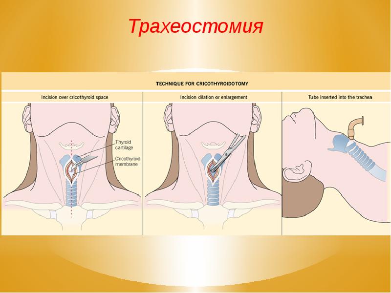 Трахеостомия топографическая анатомия презентация