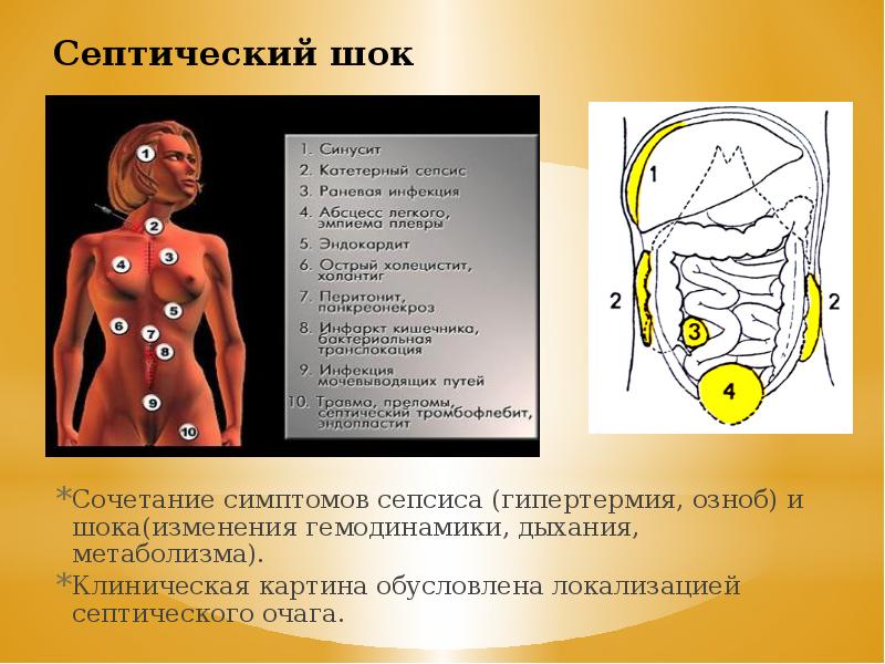 Септический шок и сепсис презентация