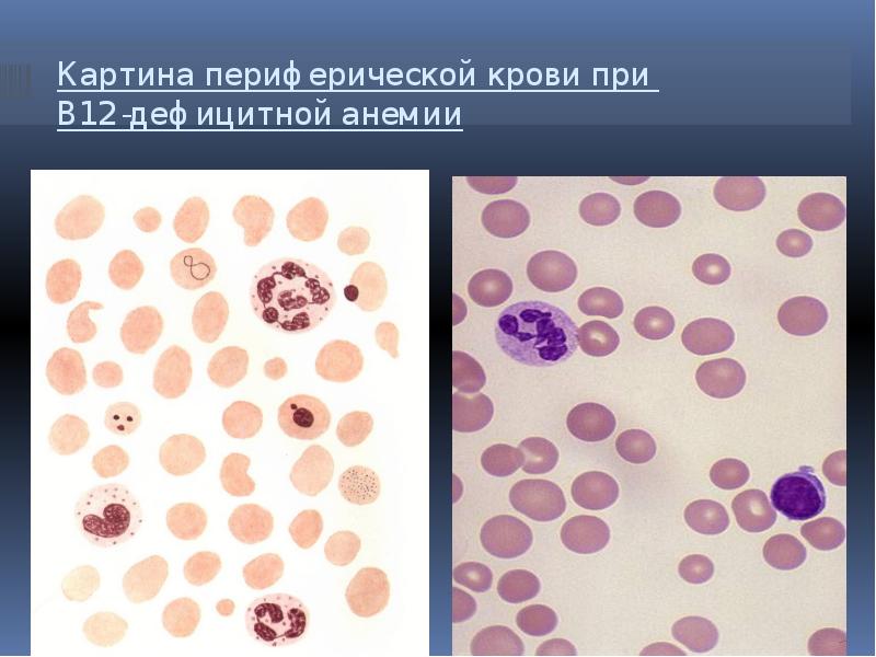 Картина крови при в12 дефицитной анемии периферической