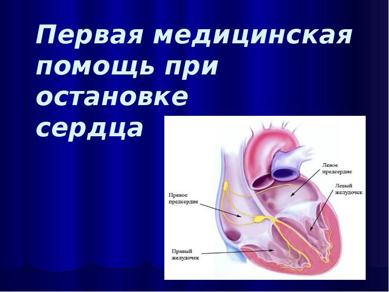 Пмп при остановке сердца презентация